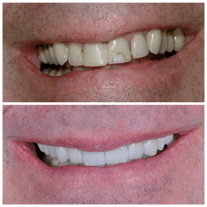 Close up photographs of a mans smile before and after having teeth whitening and cosmetic dental procedures performed.