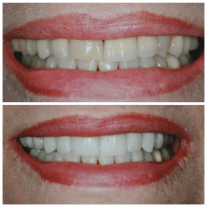 Two close up photographs of an older woman's smile before and after improving color and shape of teeth.