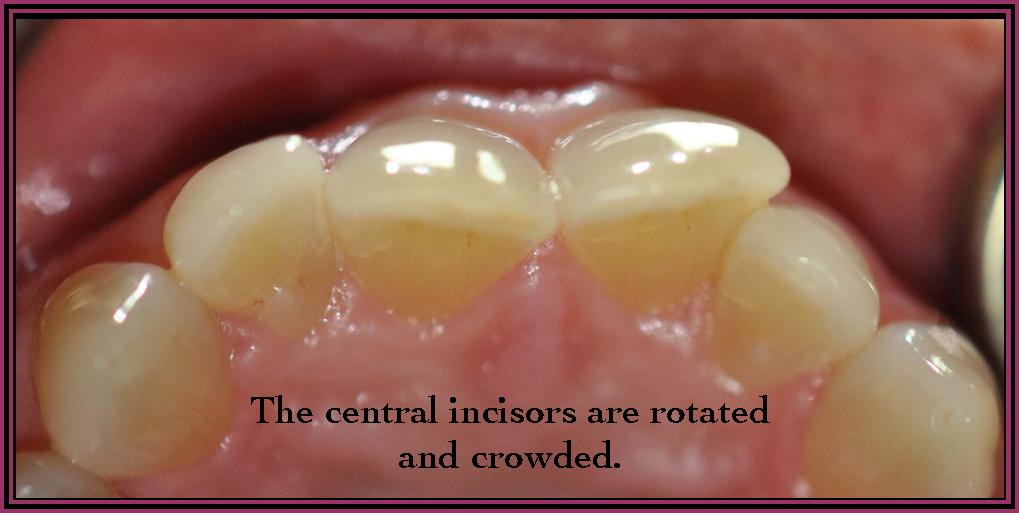 Instant Ortho 2 Close up photograph of a persons teeth. The teeth are tinted yellow, crooked and overlapping.