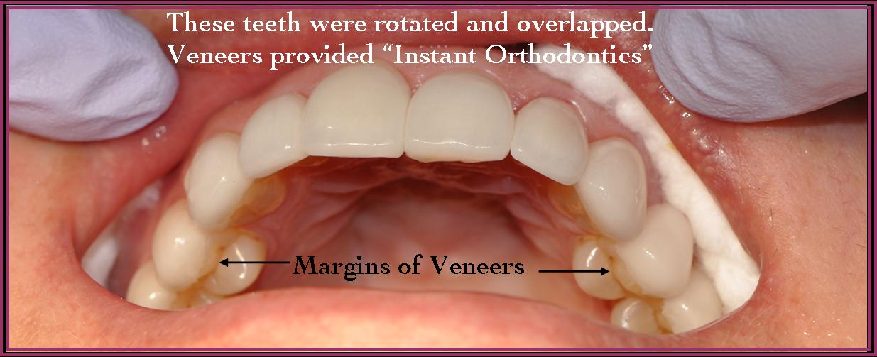 Instant Ortho 5 Close up photograph of the top row of a persons teeth after straightening teeth and correcting cosmetic dental issues.