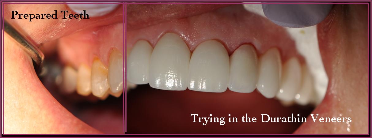 Instant Ortho 6 Two images side by side of a persons teeth before and after having adding dental veneers to straighten teeth & improve smile.