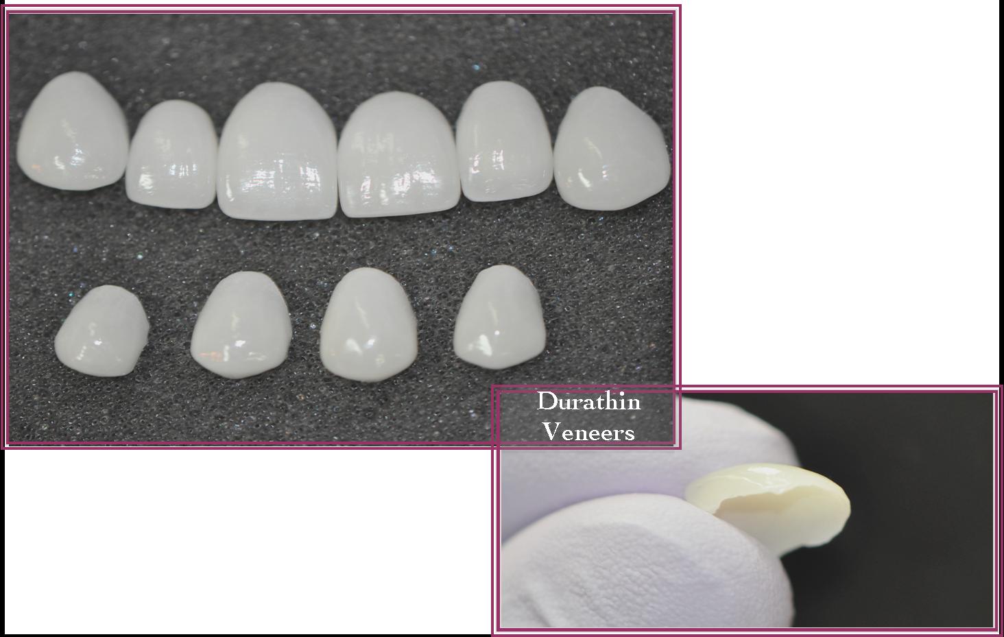 Instant Ortho 8 Photograph of dental veneers before being placed onto teeth.