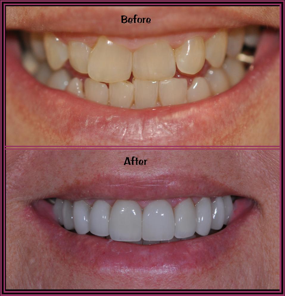 Instant Ortho Final Close up images of a persons smile before and after adding dental veneers.