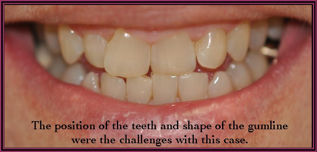 Instant ortho 1 Close up photograph of a persons mouth with crooked teeth.