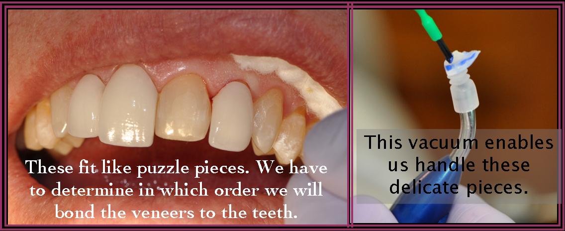 Instant ortho 7 Two images side by side. To the left are teeth before being corrected and to the right is a dental vacuum.