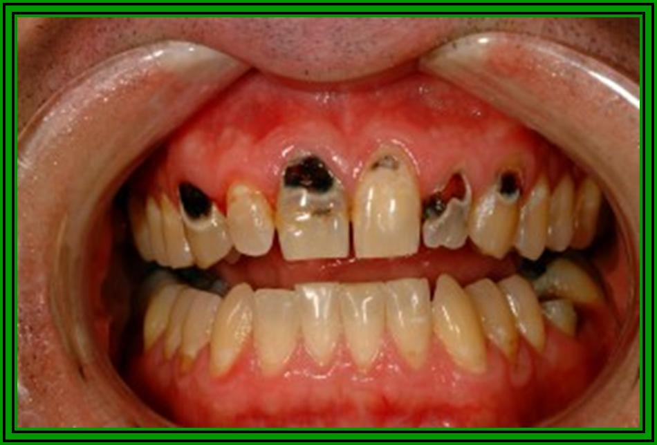 Meth Mouth