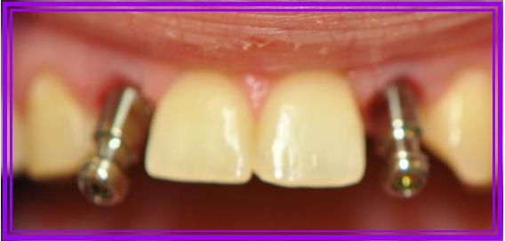 Missing Laterals 2