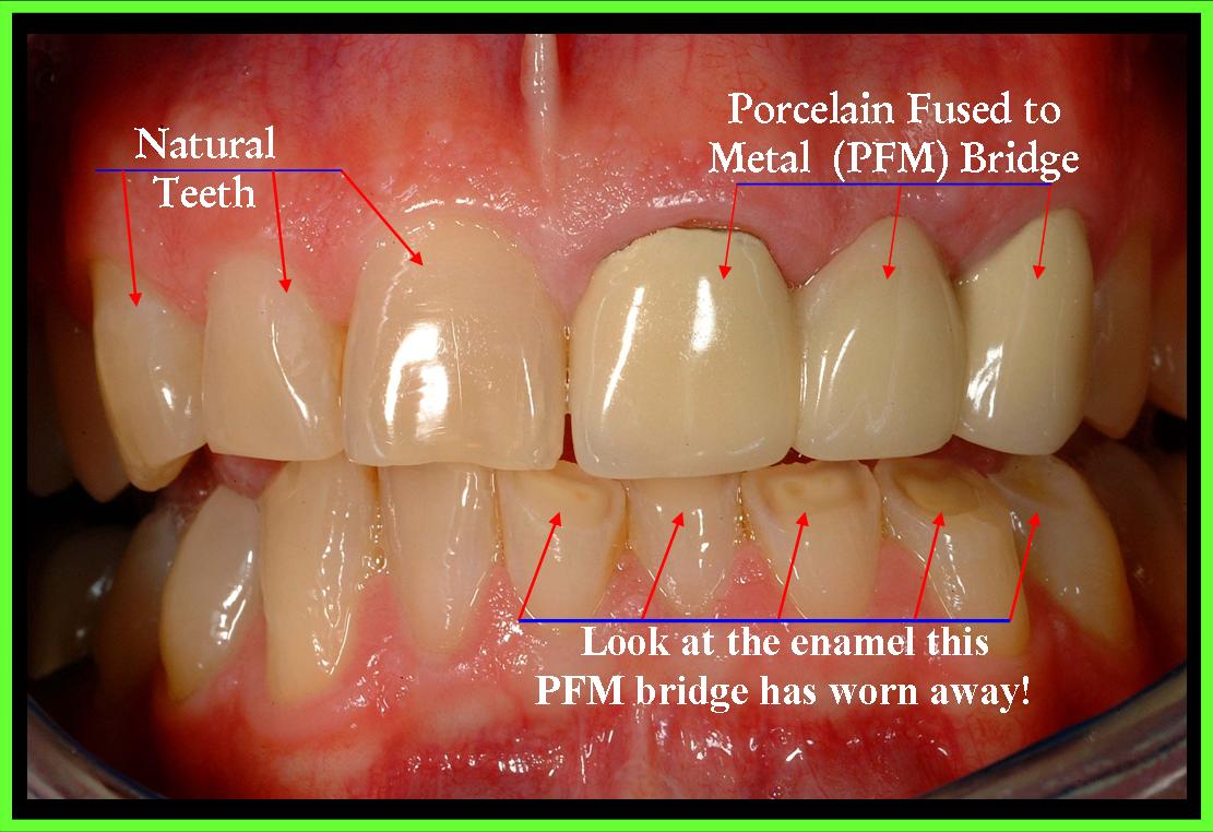 PFM VS ACC 1