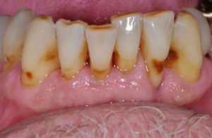 Close up photograph of decaying teeth due to a receding gum line.