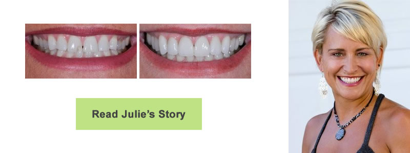 Close-up photographs of a woman's smile before and after having a chipped tooth repaired. The woman has short blonde hair.