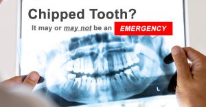 Photograph of a person holding an X-Ray of a chipped tooth.
