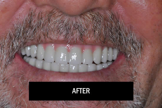 Photo of Patient After Doing Smile-In-A-Day