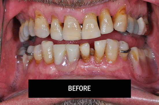 Photo of Patient Before Doing Smile-In-A-Day