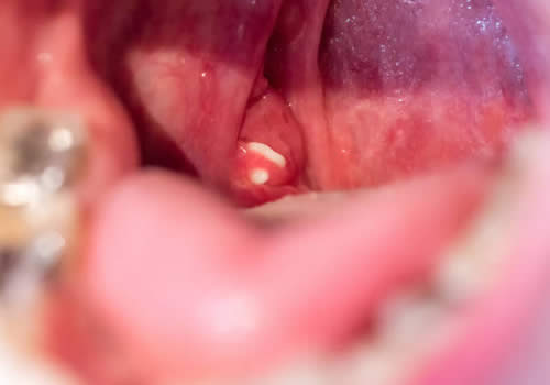 Tonsil stones in the back of the mouth