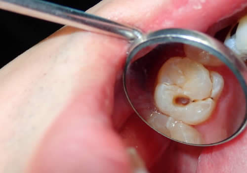 Tooth with advanced cavity