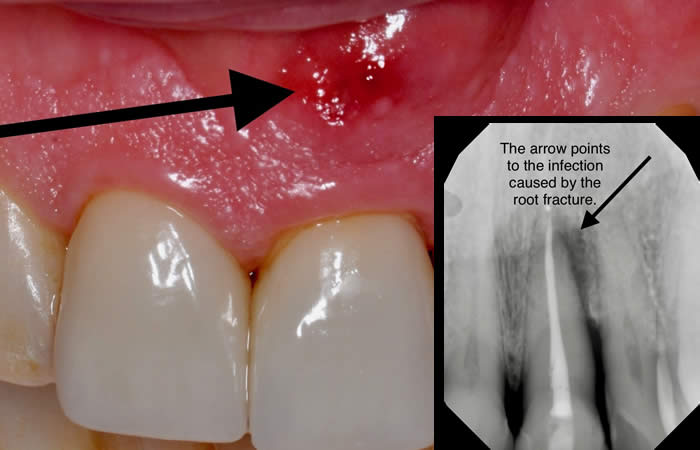 photo of mouth with fractured tooth and swelling