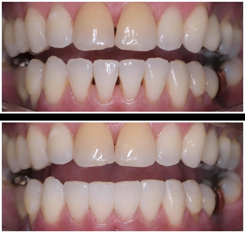Bioclear Before/After - Black Triangle Case 3