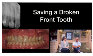 Saving a broken front tooth with Larry Saylor Dentistry in Brandon, FL.