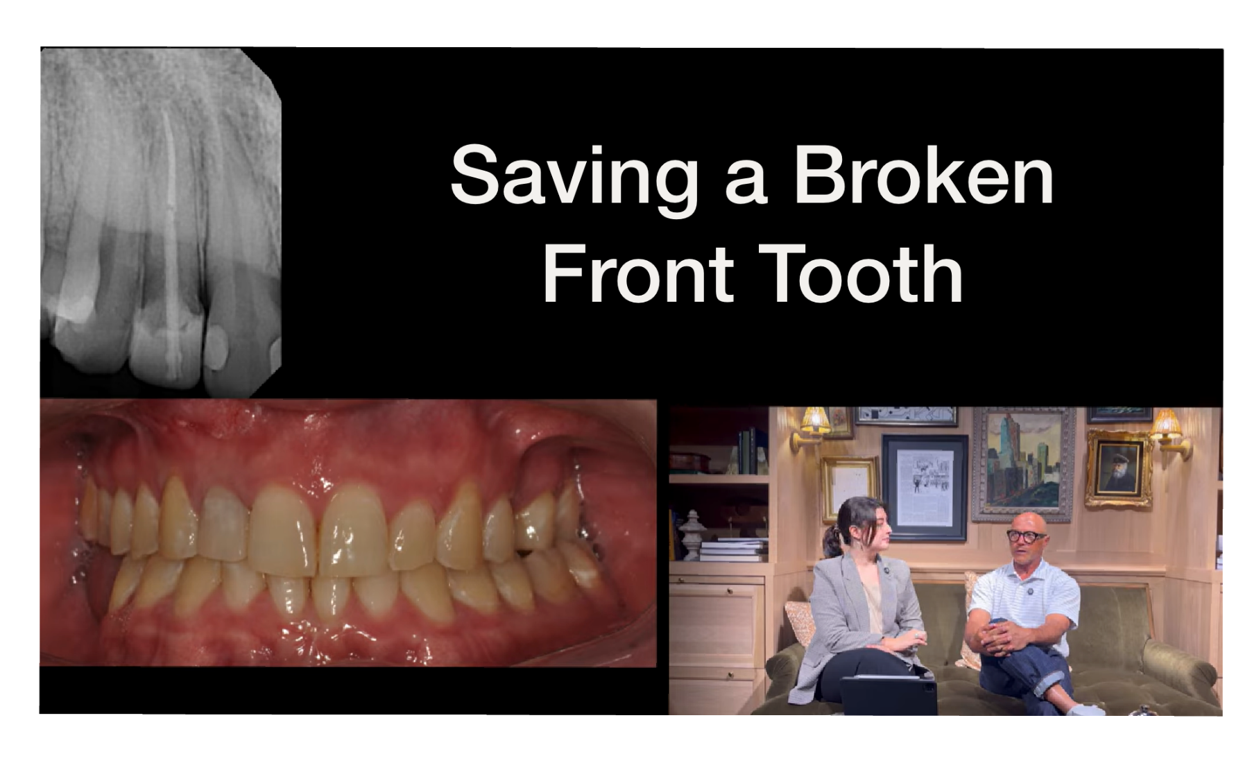 Saving a broken front tooth with Larry Saylor Dentistry in Brandon, FL.