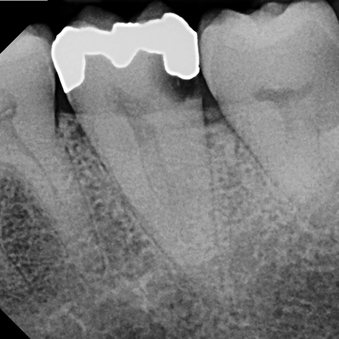 Lower left molar with decay, but still has good bone support, strong roots and a significant amount of healthy tooth structure. 